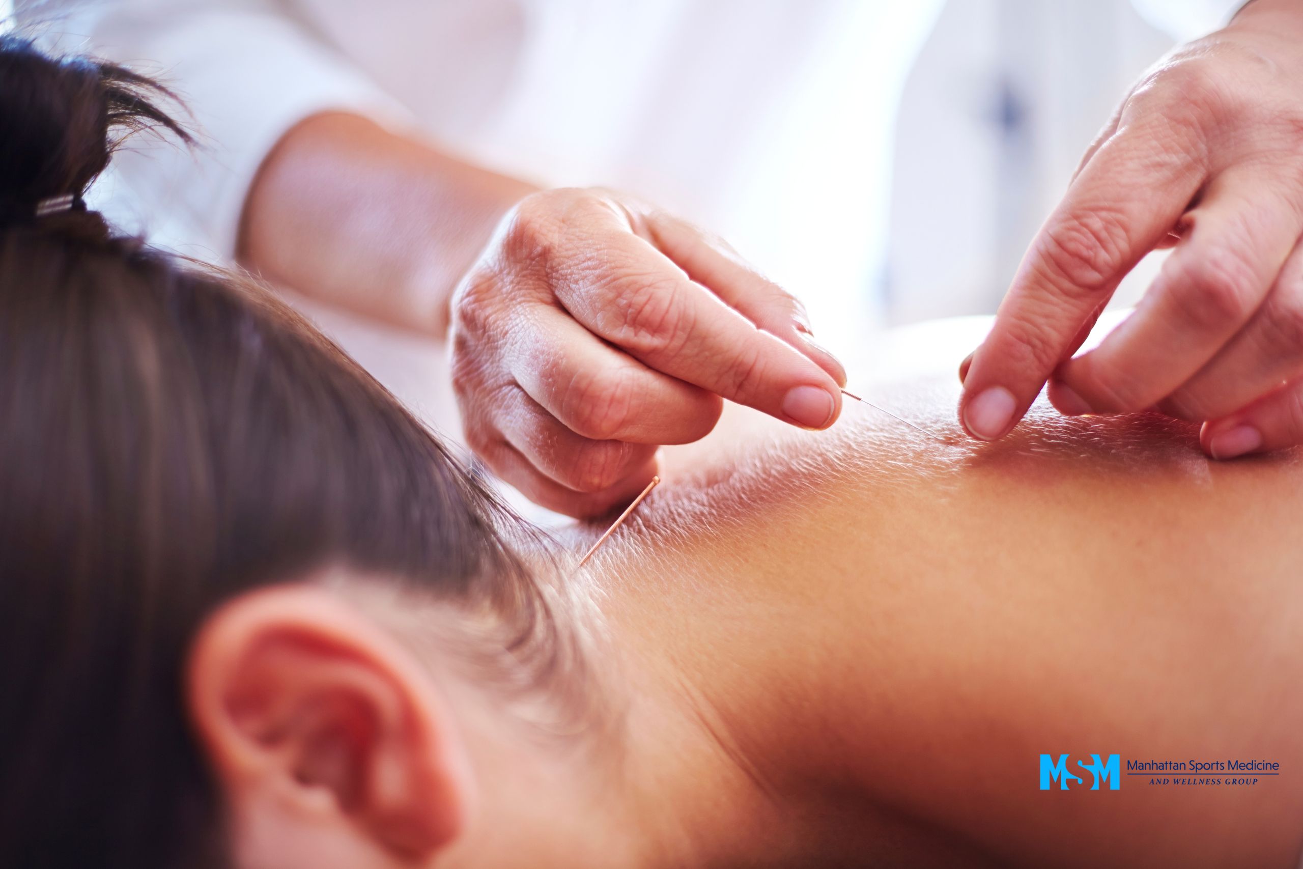 A person receives acupuncture treatment on their upper back, with close-up of practitioner's hands inserting needles. A person receives acupuncture treatment on their upper back, with close up of practitioner's hands inserting needles